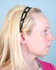 Before Hair Transplant&nbsp;Hairline